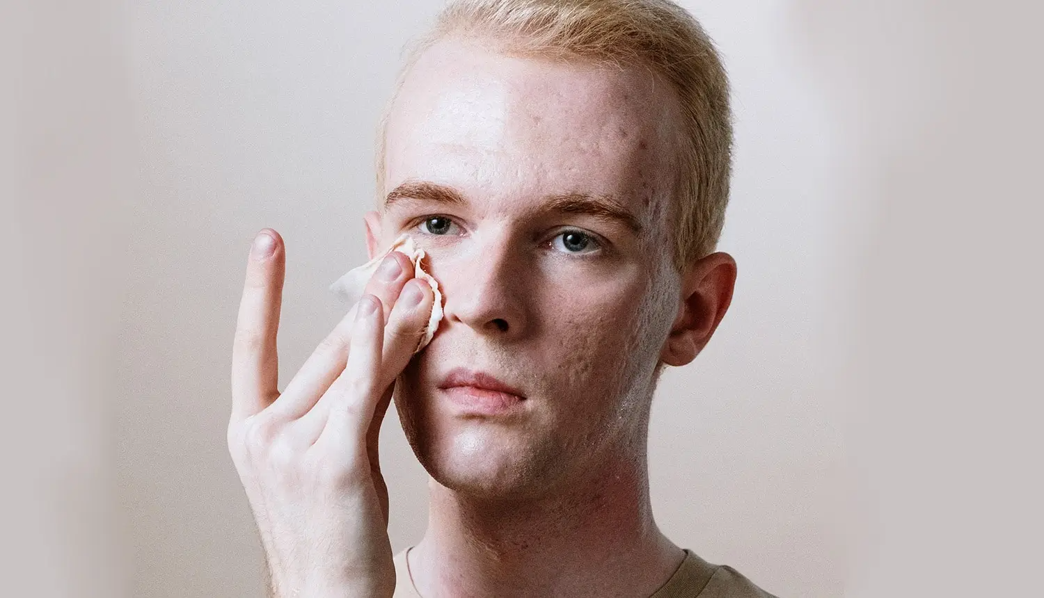De frente para a câmera, jovem loiro de pele clara e com acne, olhos azuis, cabelos curtos e camiseta bege, limpa o rosto com lenço umedecido em gel de limpeza facial.